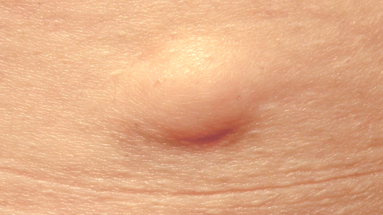 Lipoma