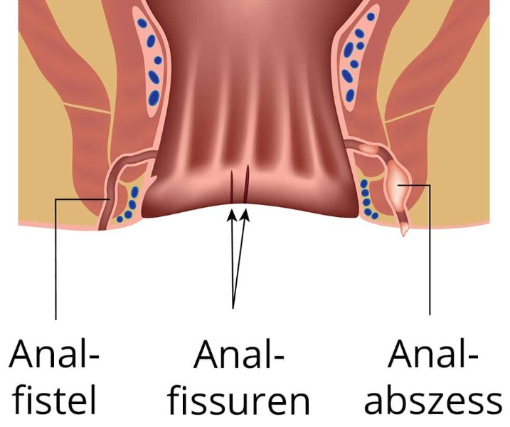 fistula